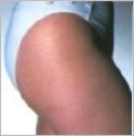 stretch Marks stretch Marks